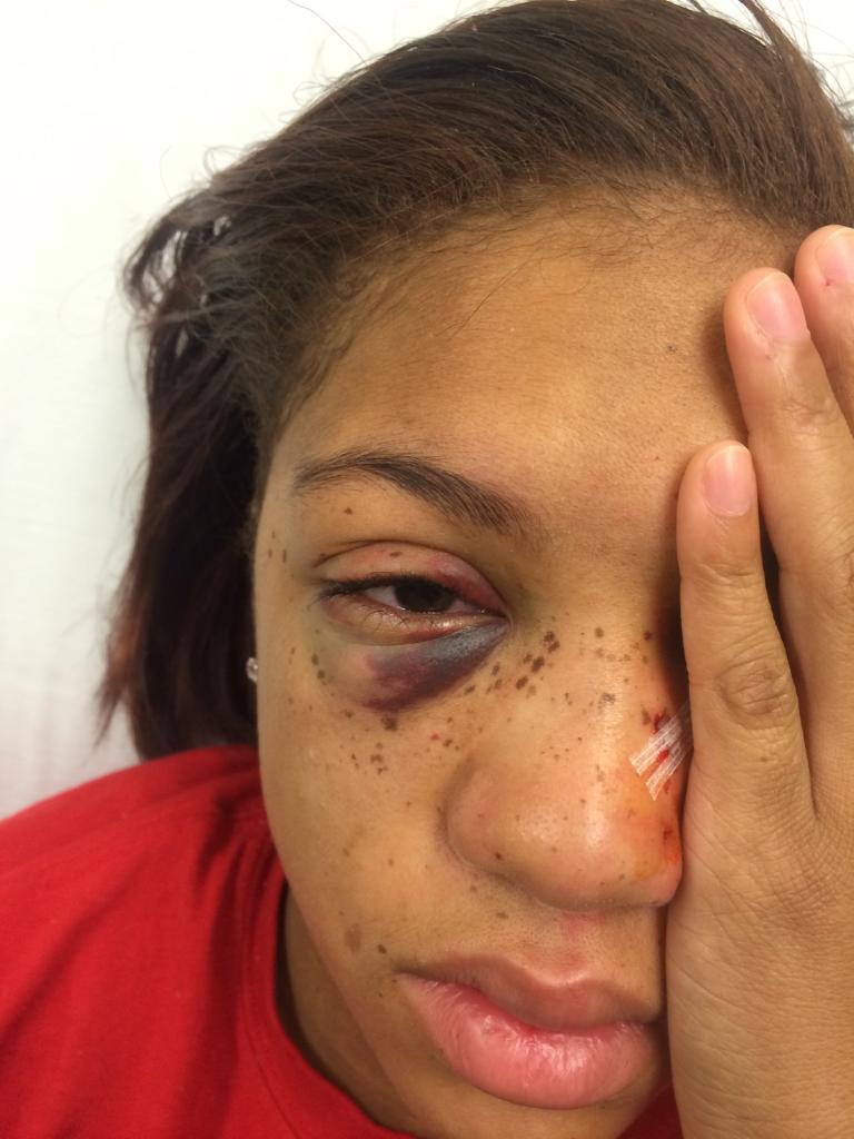 (Shay Wharton, after she was attacked by a stranger on a Route 15 Septa trolley.  Family photo)